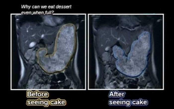 MRI scans of two people whose stomachs expanded at the sight and smell of cake
